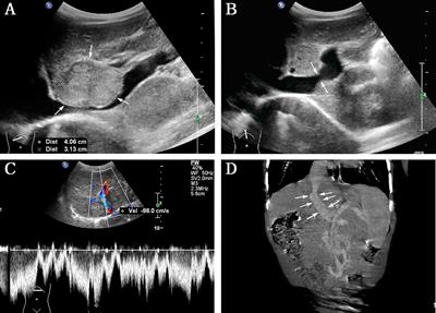 Case Report: Early detection and intervention of congenital portosystemic shunts in children